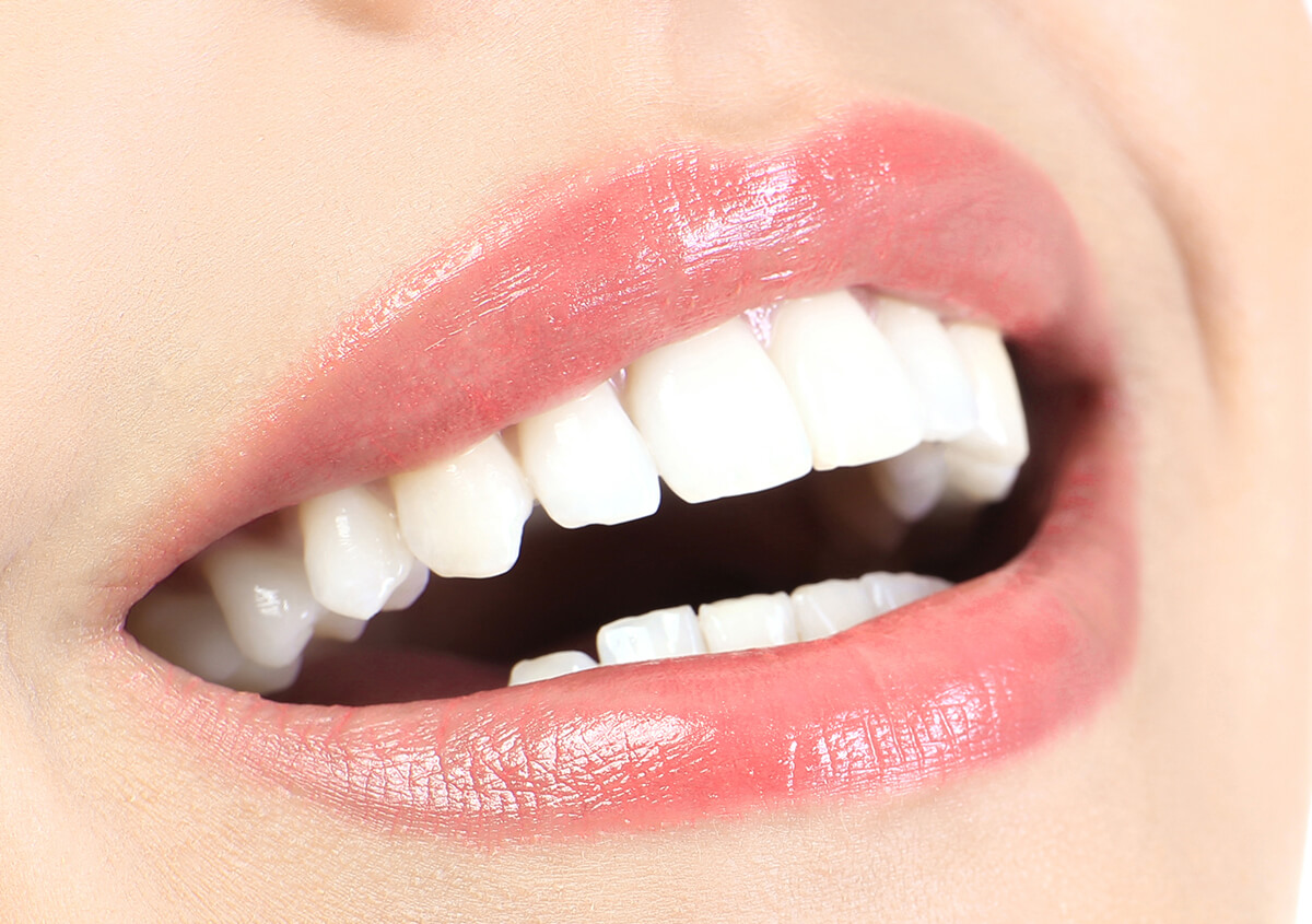 Dentist in Napier Talks to Patients About Veneers for Teeth, and Which Patients Make Good Candidates