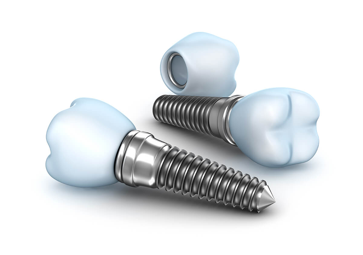 Teeth Implants Dentist in Napier Area